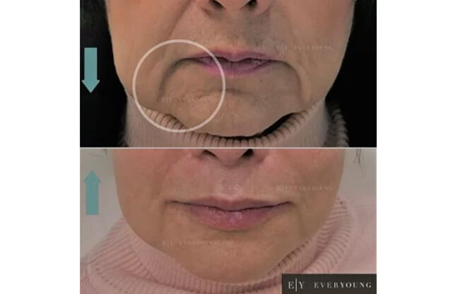 Face Sculpting and Contouring - Before & After 3 | EverYoung Skin Clinic Vancouver