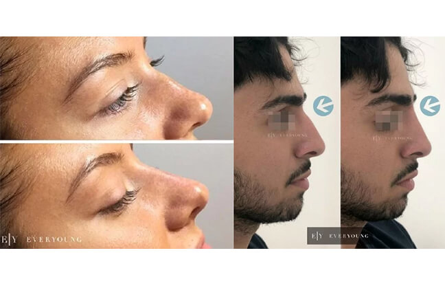 Face Sculpting and Contouring - Before & After 4 | EverYoung Skin Clinic Vancouver