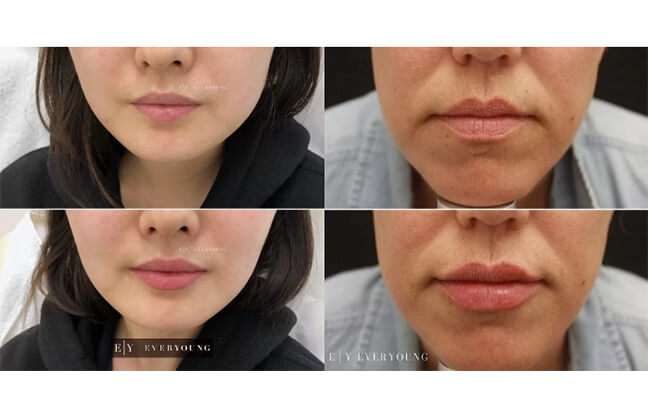 Face Sculpting and Contouring - Before & After 5 | EverYoung Skin Clinic Vancouver