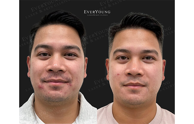 Hollywood Peel Treatment - Before & After | EverYoung