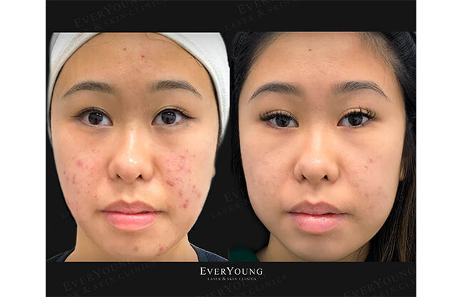 Hollywood Peel Treatment - Before & After | EverYoung Skin Clinic