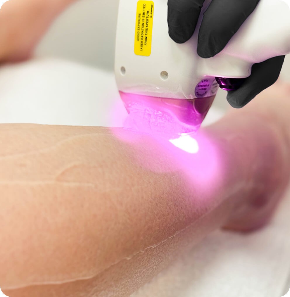 Laser Hair Removal - Conditions | EverYoung Vancouver