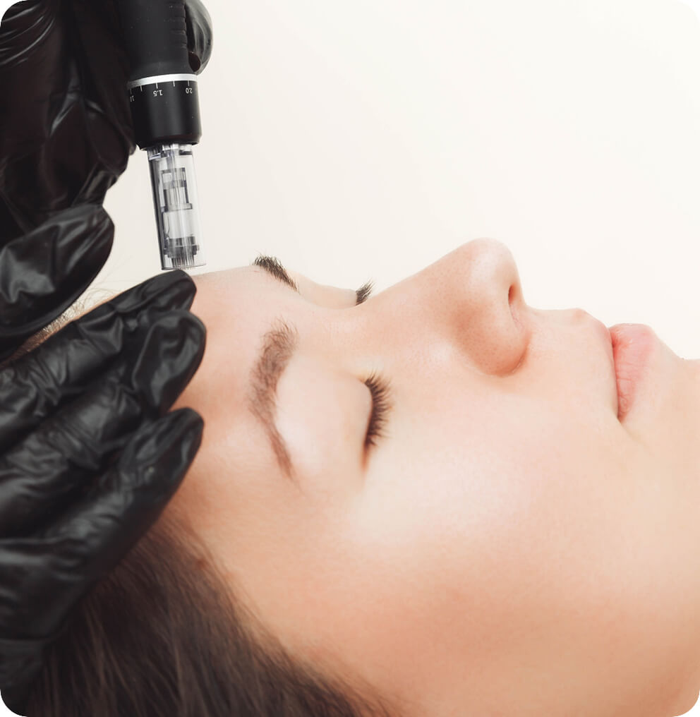 Microneedling for Hair Loss in Vancouver | EverYoung Skin Clinic