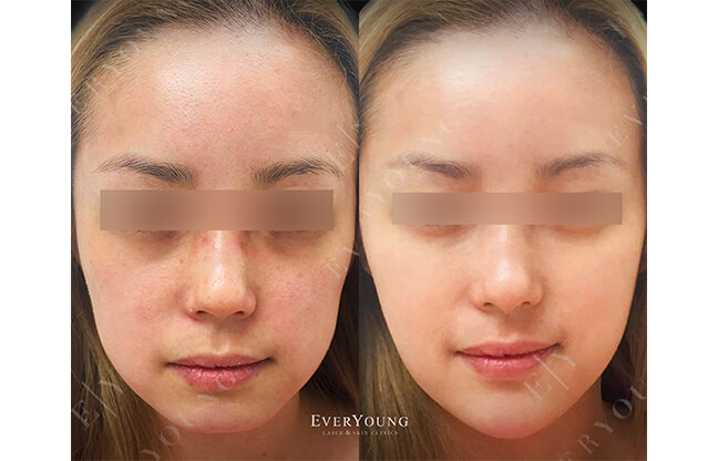Under Eye Fillers - Before & After 5 | EverYoung Skin Clinic Vancouver