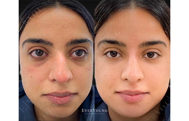 Under Eye Fillers - Before & After 4 | EverYoung Skin Clinic Vancouver