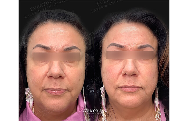 Under Eye Fillers - Before & After 2 | EverYoung Skin Clinic Vancouver