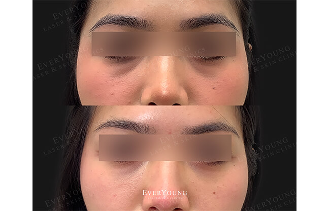 Under Eye Fillers - Before & After 1 | EverYoung Skin Clinic Vancouver