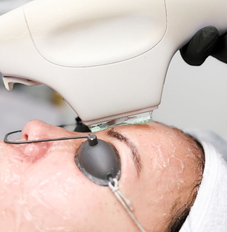 BBL BBL Photofacial Vancouver | EverYoung Skin Clinic