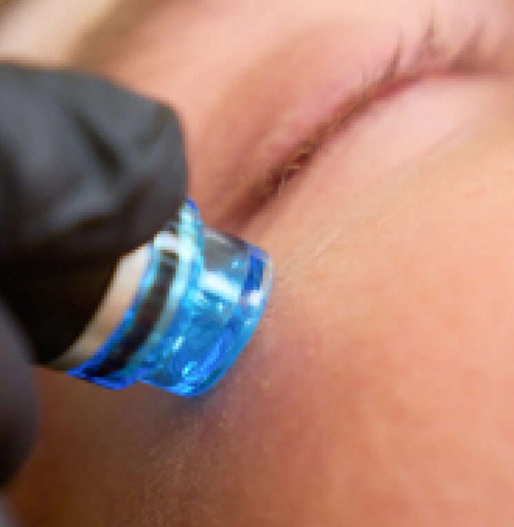 HYDRAFACIAL HydraFacial MD® Treatment Vancouver | EverYoung Skin Clinic