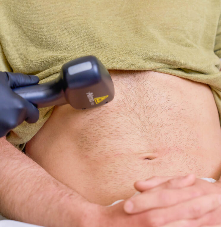 LASER-HAIR-REMOVAL Laser Hair Removal Vancouver | EverYoung Skin Clinic