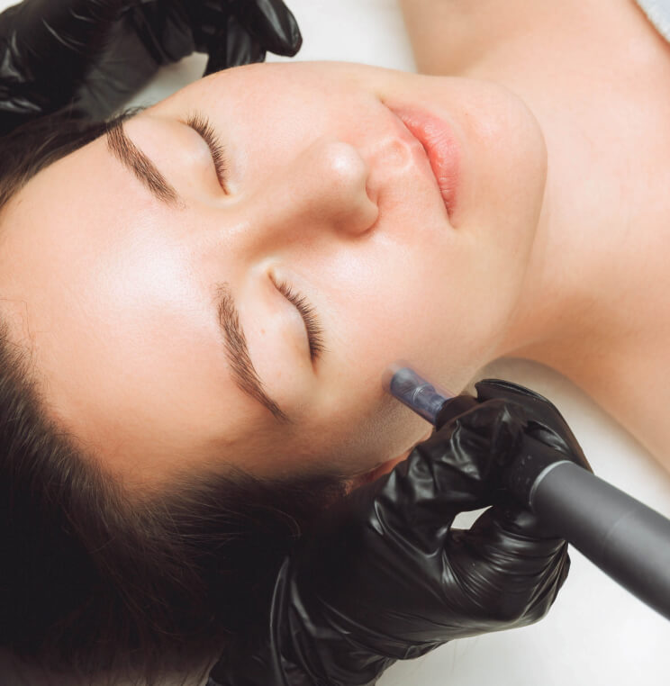 MICRONEEDLING Microneedling Vancouver | EverYoung Skin Clinic