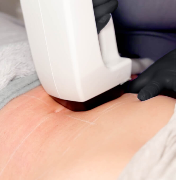MINIFX InMode MiniFX Treatment Vancouver | EverYoung Skin Clinic