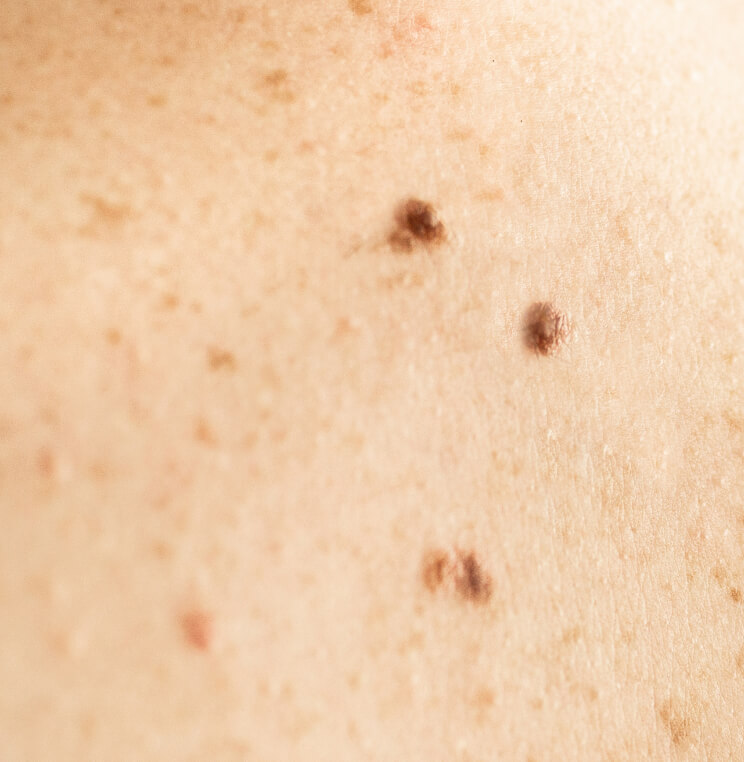 MOLE-REMOVAL Mole Removal Vancouver | EverYoung Skin Clinic