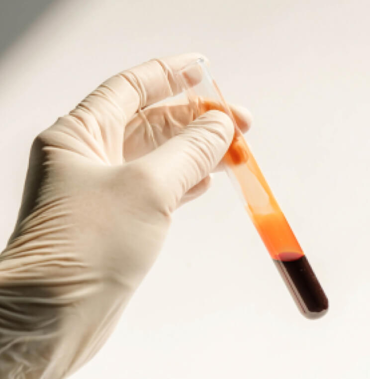 PRP-FACE PRP Vampire Facial Vancouver | EverYoung Skin Clinic