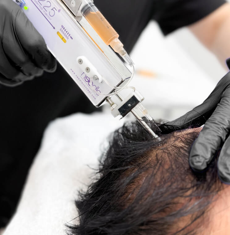 PRP-HAIR PRP for Hair Loss Vancouver | EverYoung Skin Clinic