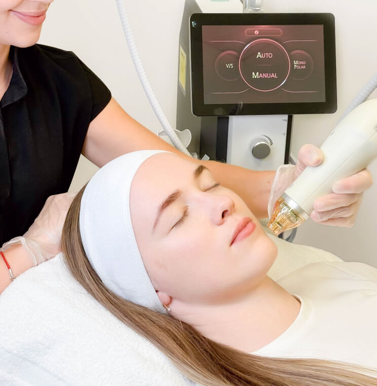 SECRETRF Secret™ RF Microneedling Vancouver | EverYoung Skin Clinic
