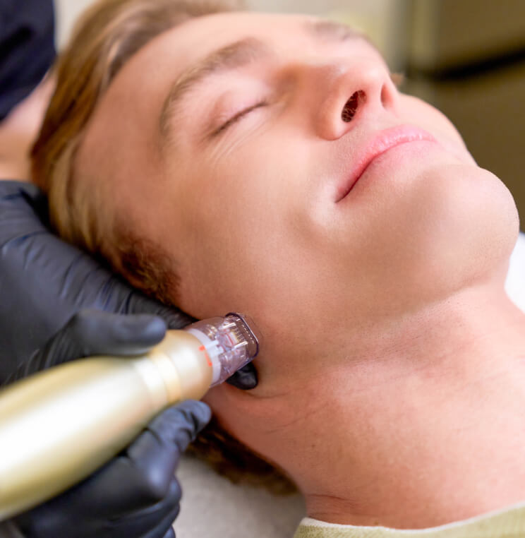 SYLFIRM-X Sylfirm X Treatment Vancouver | EverYoung Skin Clinic