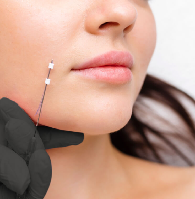 THREADLIFT Thread Lift & Silhouette InstaLift Vancouver | EverYoung Skin Clinic