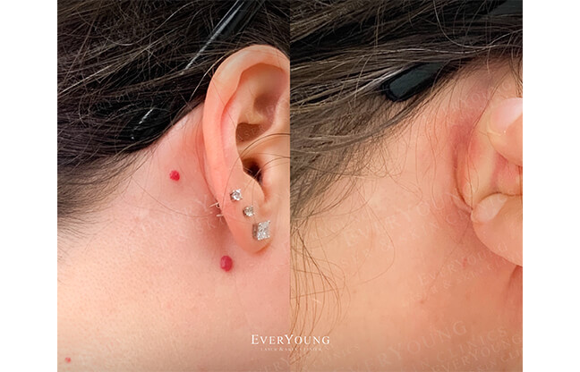 Excel V™ Laser - Before & After 2 | EverYoung Skin Clinic Vancouver