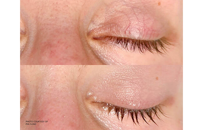 Excel V™ Laser - Before & After 3 | EverYoung Skin Clinic Vancouver