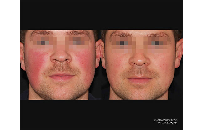 Excel V™ Laser - Before & After 4 | EverYoung Skin Clinic Vancouver