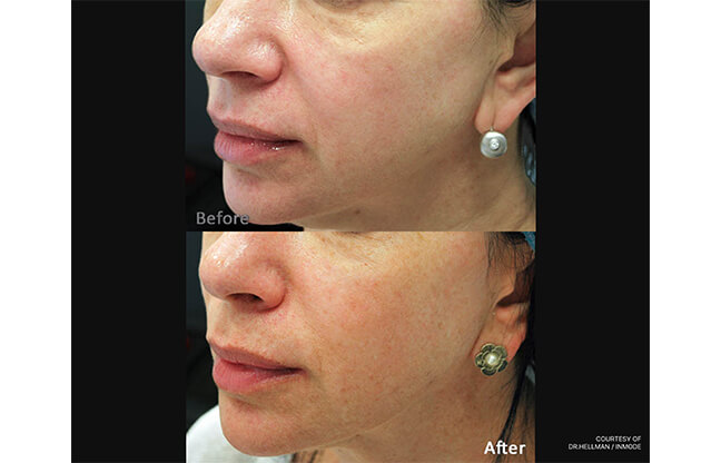 Forma Skin Tightening Treatment - Before & After 1 | EverYoung Clinic Vancouver