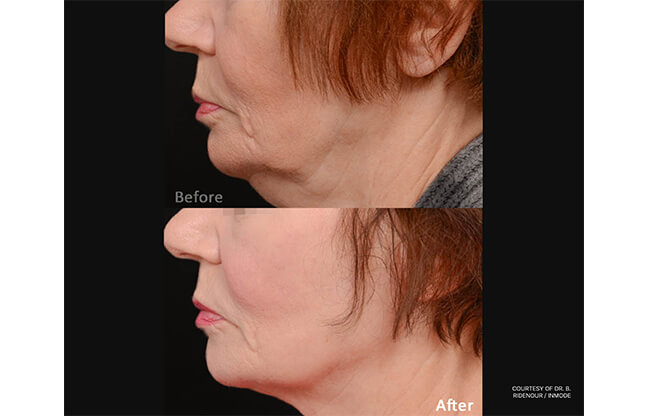 Forma Skin Tightening Treatment - Before & After 2 | EverYoung Clinic Vancouver