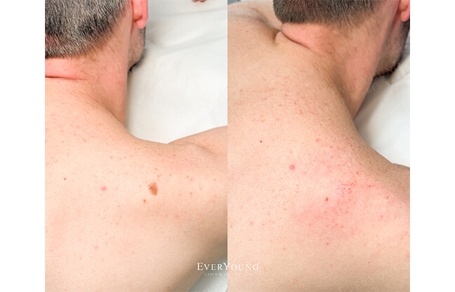 Mole Removal - Before & After 2 | EverYoung Skin Clinic