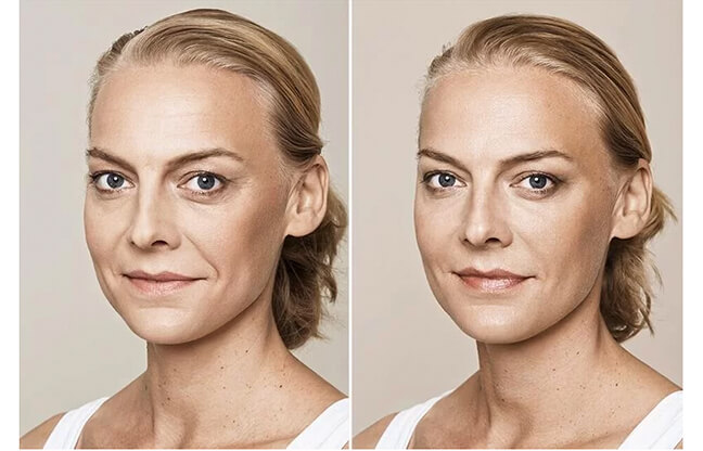 Restylane Skin Boosters Treatment - Before & After 2 | EverYoung Skin Clinic Vancouver