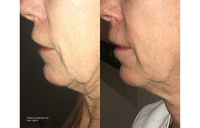 RF Microneedling Treatment - Before & After 1 | EverYoung Medispa Skin Clinic