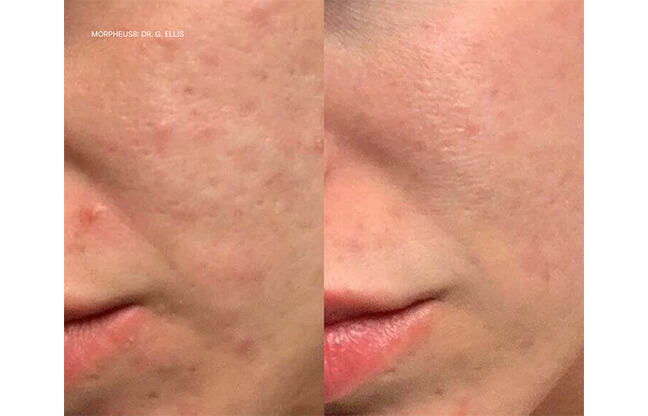 RF Microneedling Treatment - Before & After 2 | EverYoung Medispa Skin Clinic