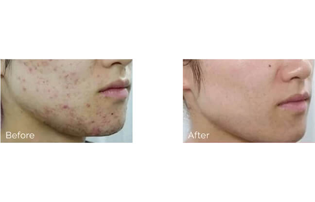 Acne Treatments - Before & After 1 | EverYoung Skin Clinic