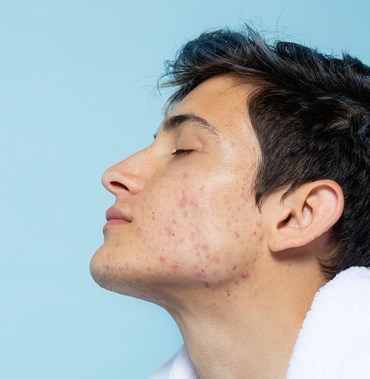 Conditions: Acne - Men | EverYoung Skin Clinic