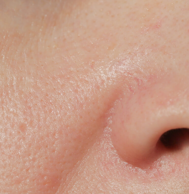 Conditions: Congestions & Blackheads | EverYoung Skin Clinic