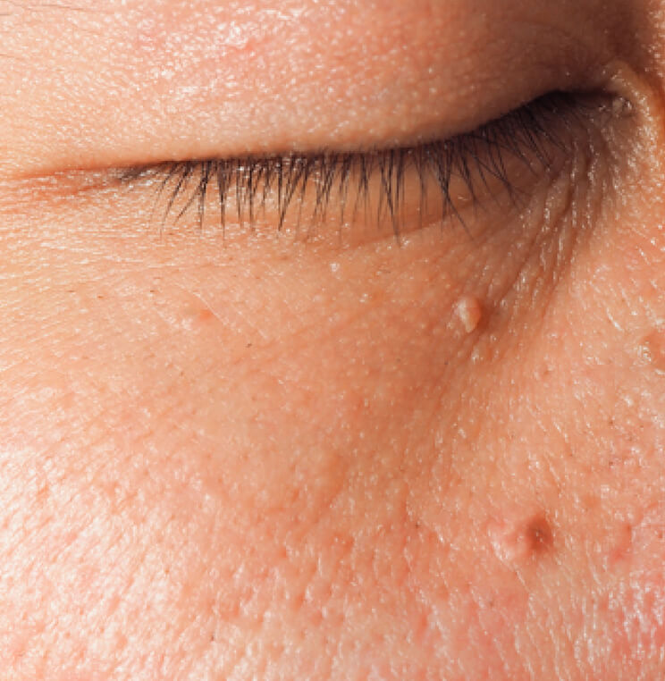 Conditions: Skin Tags - Men | EverYoung Skin Clinic