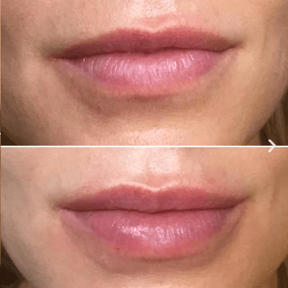 Lip Fillers Injections - Before & After 5 | EverYoung Skin Clinic Vancouver