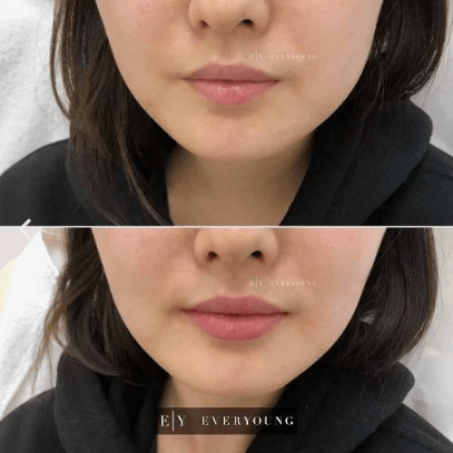 Lip Fillers Injections - Before & After 6 | EverYoung Skin Clinic Vancouver