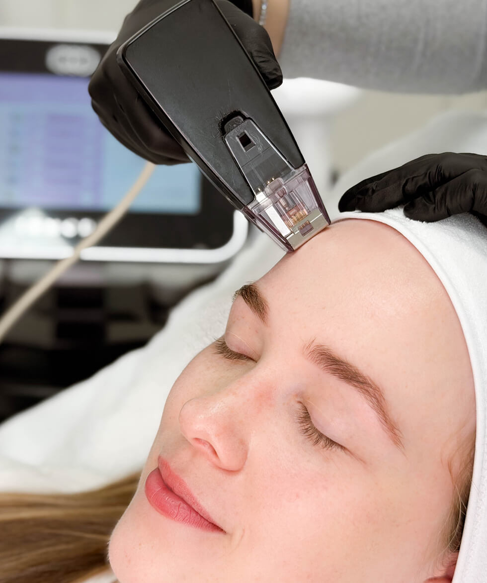 morpheus8-port-coquitlam Morpheus8 in Vancouver, Burnaby, North Vancouver, and Port Coquitlam | EY